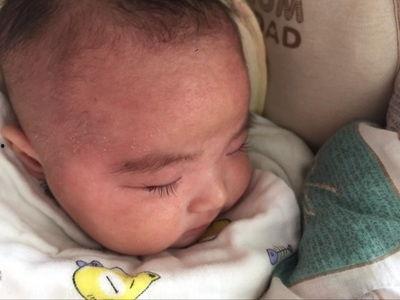 孩子湿疹吃瓜能行吗